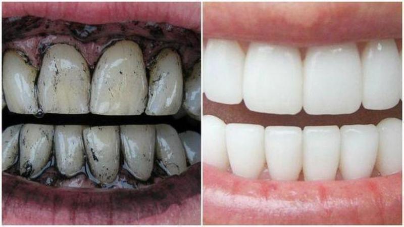 Как отбелить зубы углем
